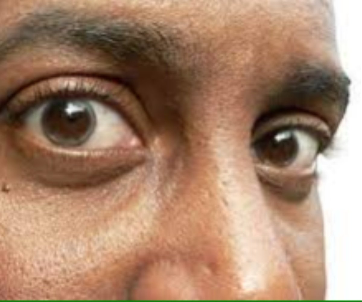 glaucoma